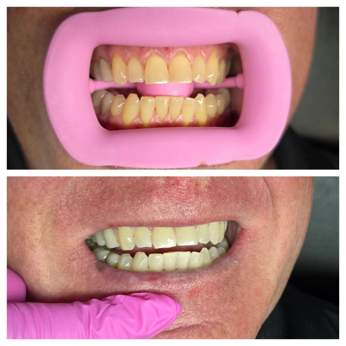 Teeth Whitening
