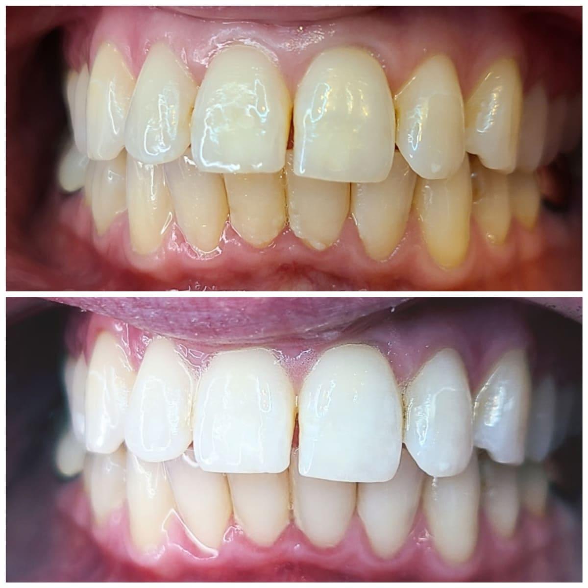 24K Gold Whitening for Sensitive Teeth